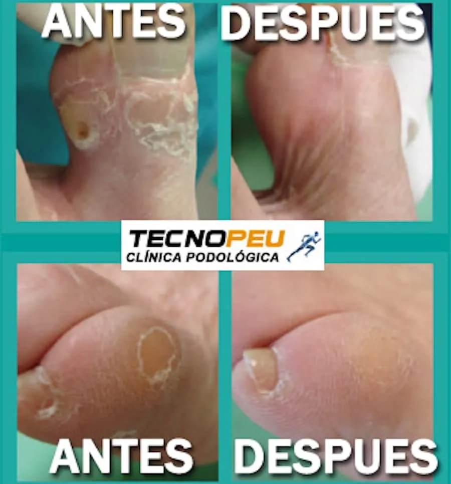 aquamind tratamiento callos pies