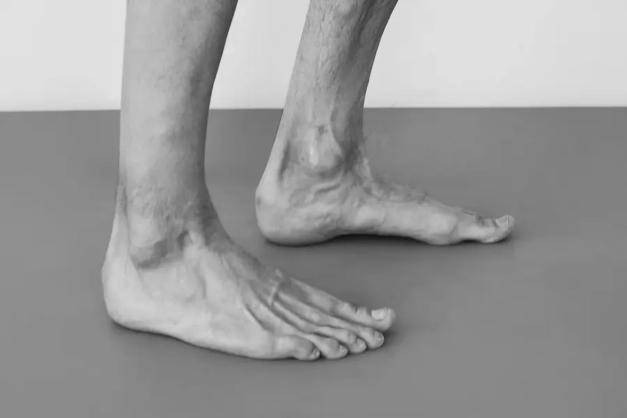 hiperpronacion insuficiencia tibial hiperpronacion insuficiencia tibial