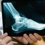 astragalo vertical congenito