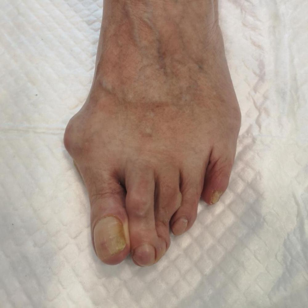 Dedos en garra antes