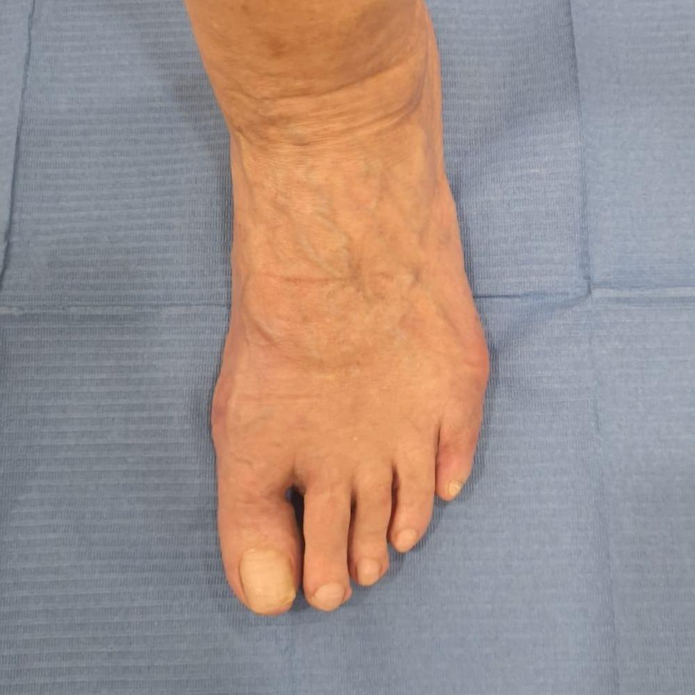 Dedos en garra después